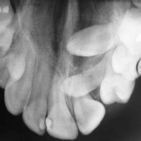 Maxillary Occlusal Radiograph Shows Normal Healing State After Months