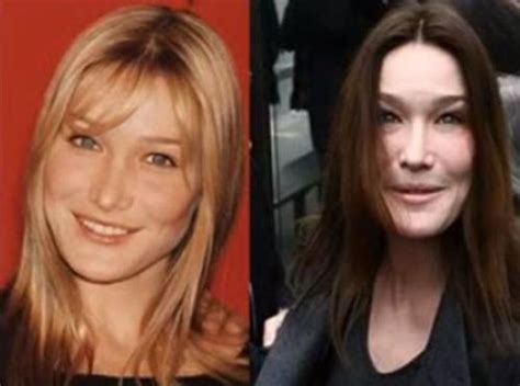 Shocking Cases Of Plastic Surgery Disasters Wtf Gallery Ebaums World