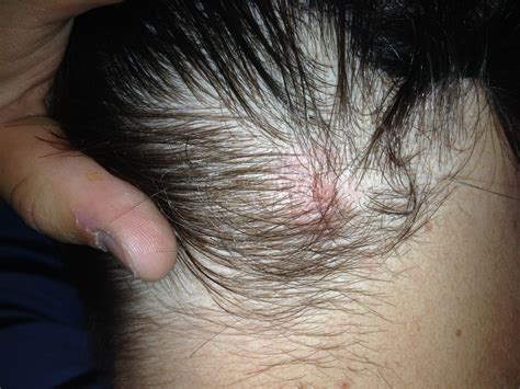 Pimple Like Bumps On Scalp Pictures Photos