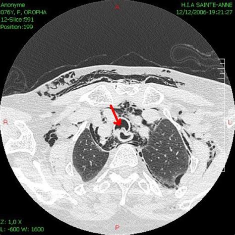 Thoracic Ct Showing Posterior Tracheal Rupture Arrow Download