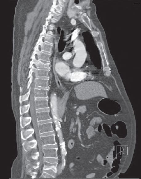 Sagittal Section Abdomen