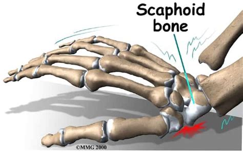 Scaphoid Fracture Mississauga Chiropractor And Physiotherapy Clinic