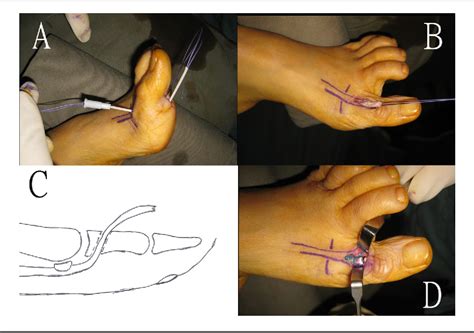 Figure 2 From Flexor Hallucis Longus Tendon To Extensor Hallucis Longus