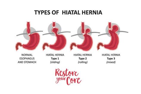 Types Of Hernia Ryc Hot Sex Picture