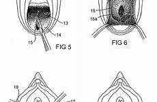 repair patents vagina drawing organ pelvic damaged