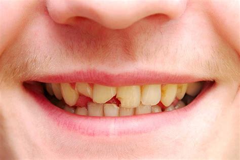 What To Do If You Crack Chip Or Break A Tooth Radiance Dental