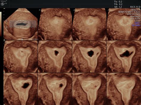 patients prefer transvaginal ultrasound over mri empowered women s health