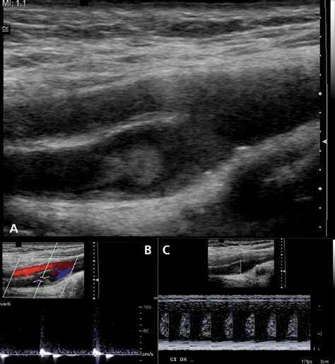 Case A B Mode Sonogram Showing A Thrombus In The Internal Carotid