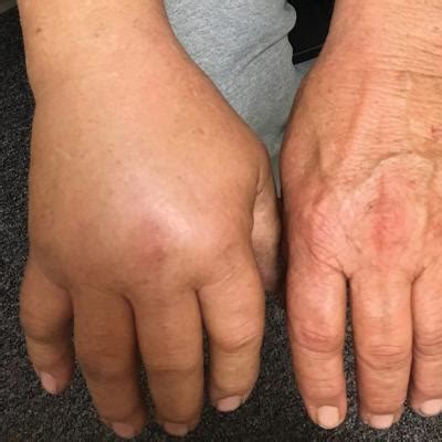 Year Old Man Upper Extremity Pain Edema Recent Diagnosis Of Heart Failure Dx