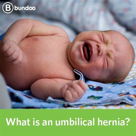 What Is An Umbilical Hernia