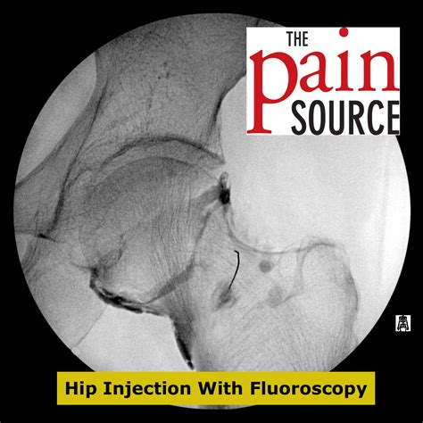 Or having an injection bob and brad discuss how to stop hip bursitis without having. Hip Joint Injection With Fluoroscopy - Technique and Tips ...