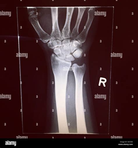 Broken Wrist Hi Res Stock Photography And Images Alamy