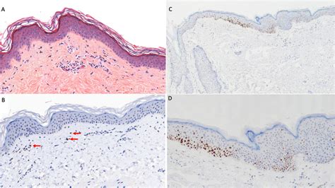 Skin Histopathologic And Immunohistochemical Examination A Mild