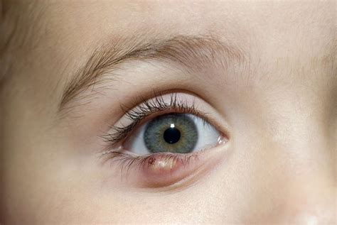 Chalazion Eyelid Bump Symptoms And Treatments