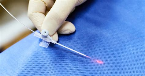 What To Expect During Your Vein Ablation Procedure