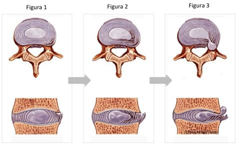 Hérnia De Disco Lombar Infográfico