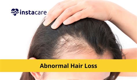 Reasons Why You Are Facing Abnormal Hair Loss