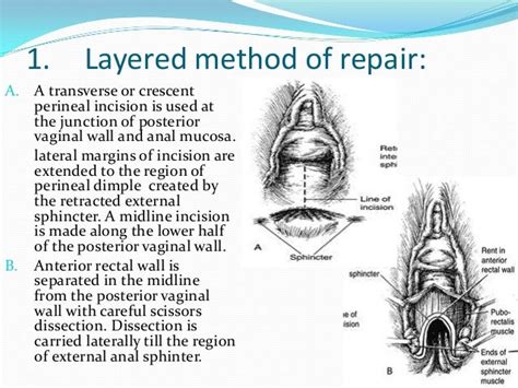 Perineal Lacerations