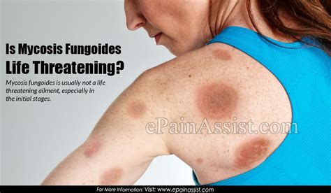 Is Mycosis Fungoides Life Threatening
