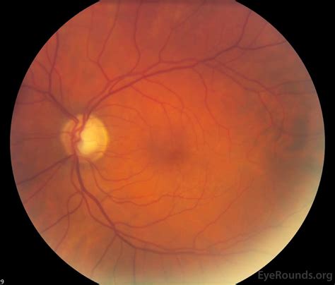 Neovascular Glaucoma