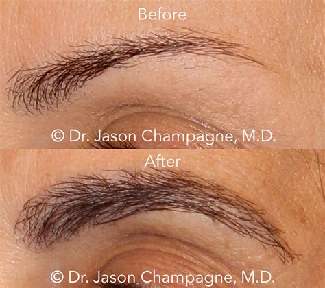 Find Your Perfect Shape Eyebrow Hair Transplantation Which Eyebrow