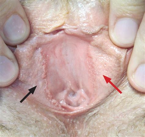 Vestibular Papillae Vulva
