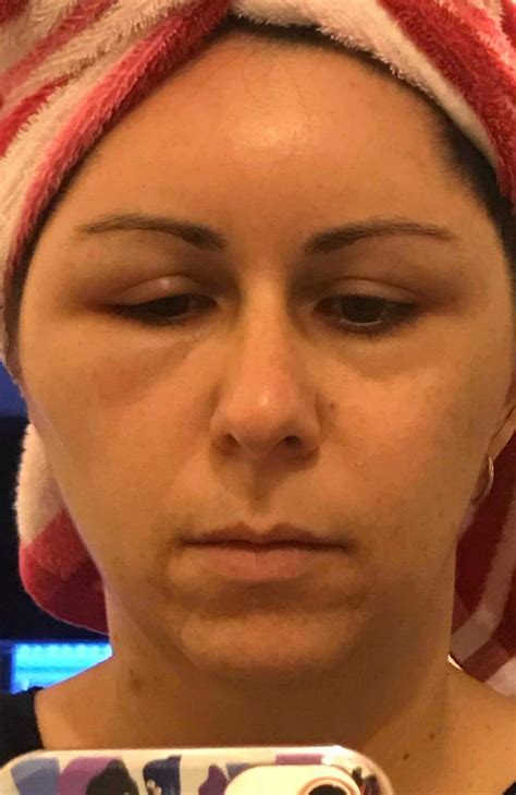 Womans Head Swells Like A Balloon After Shocking Allergic Reaction To