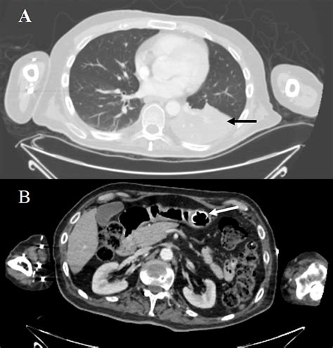 Cureus Massive Incidental Pneumoperitoneum In An Amyotrophic Lateral