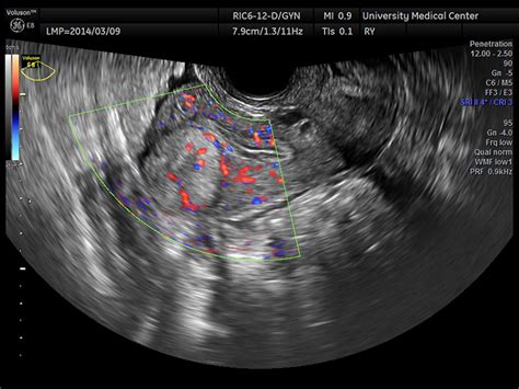 Vaginal Ultrasound Showing Atrophy Of The Uterus And Ovaries Hot Sex