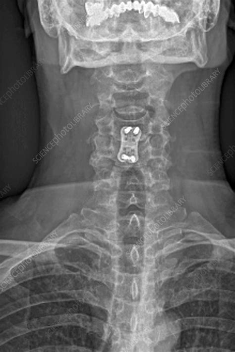 Treatment Of Neck Arthritis X Ray Stock Image C0017422 Science