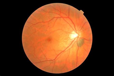 Comprehensive Eye Exams Ophthalmologist Union City Neovision
