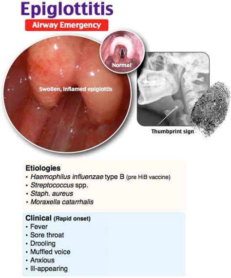 Epiglottitis A Anesthesia And Intensive Care Knowledge