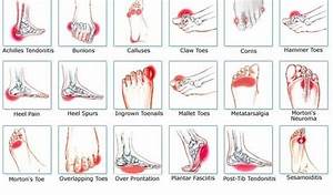 Plantar Fasciitis Boot Relive Your Severe And Chronic Quickly