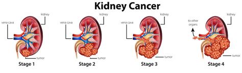 Renal Cell Carcinoma Causes Risk Factors Symptoms Prognosis And Treatment