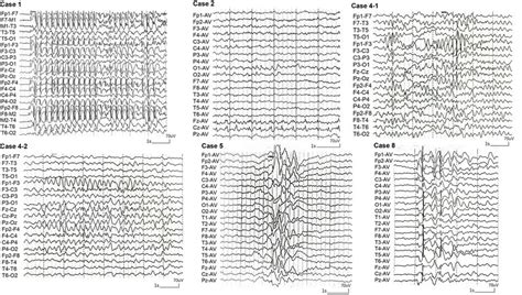 Representative Interictal Eeg In The Cases With Bsn Mutations