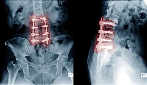 Affordable Spinal Fusion Surgery Cost In India Samarth