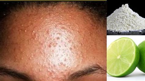 How To Get Rid Of Small Bumps On Face And Forehead Simple Home Remedy