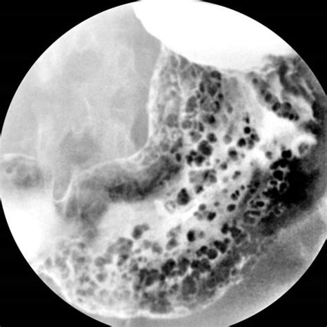 Gastric Polyps Radiology Key