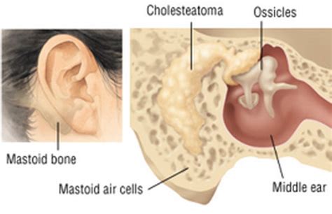 Lump Behind Ear Hard Painful Small Swollen On Ear Lobe