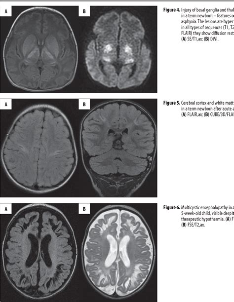 Figure 4 From Mri Patterns Of Hypoxic Ischemic Brain Injury In Preterm