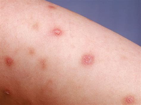 Prurigo Nodularis Pn Is A Skin Condition Which Is Marked By The