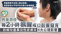 兒童敏感︳男童濕疹每2小時痕醒戒口影響發育 專家拆解兒童異位性皮膚炎4大心理影響 - 晴報 - 健康 - 兒科百問 - D220202