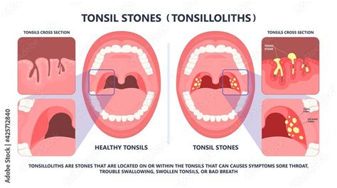 Vetor Do Stock Tonsil Stones Crypts Viral Virus Gland Strep Throat