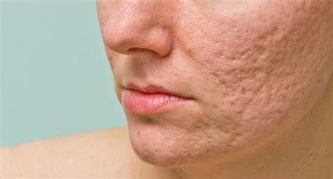 Acne Scars The Consequences Of Acne Eucerin