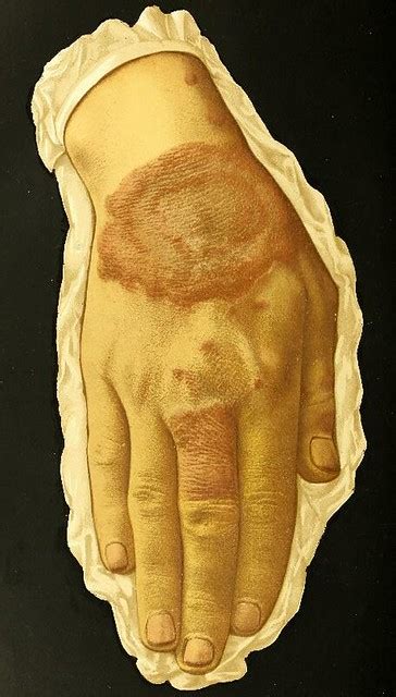 This Image Is Taken From A Pictorial Atlas Of Skin Disease Flickr