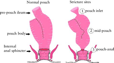 Pouch Stricture Locations Download Scientific Diagram