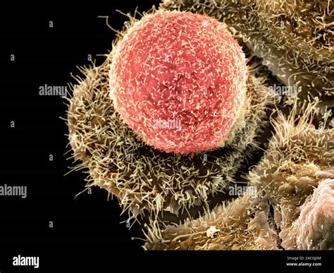 La Infección Por Clamidia Color Análisis Micrografía De Electrones De Un Cáncer De Cérvix De
