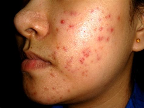Moderate Acne Frequently Asked Questions Skin Care Tips From