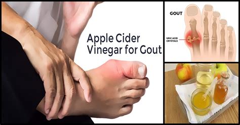 Help Treat Gout With Apple Cider Vinegar Dr Farrah Md