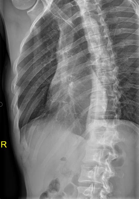 Rib Fractures Right 4th 6th Image